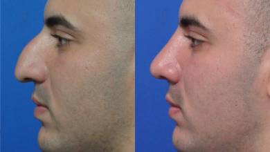 پزشکی جراحی زیبایی بینی؛ تاریخ را با عنوان دیگری تکرار کنید