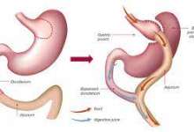 جراحی | چاقی