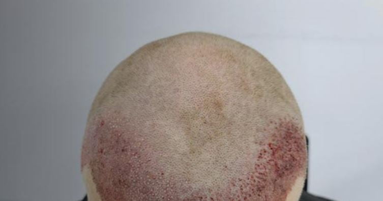 کاشت مو کاشت مو