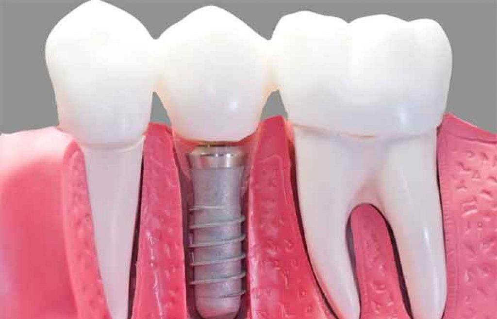 ایمپلنت | مشهد