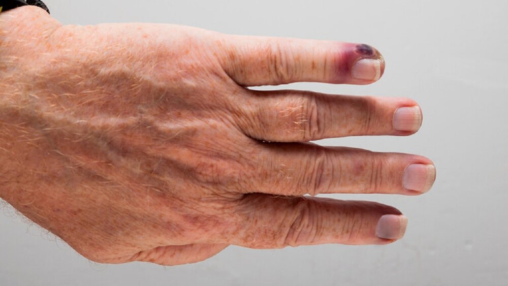 پزشکی فوت سالانه ۱۱ میلیون نفر در جهان بر اثر ابتلا به « سپسیس»