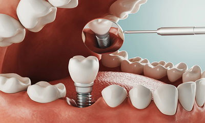 ایمپلنت ایمپلنت
