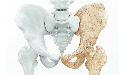 پزشکی پوکی استخوان، مهمترین عارضه یائسگی است