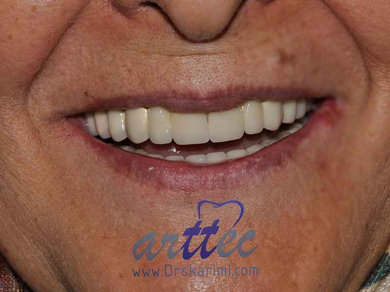 پزشکی How to implant front teeth