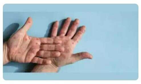 پزشکی نظر کارشناسان آمریکایی درباره شیوع «آبله میمونی»