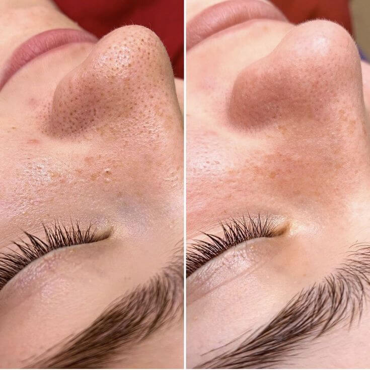 پاکسازی | پوست